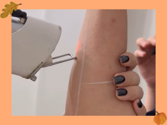 بهترین زمان برای لیزر موهای زائد